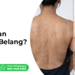 body peeling kulit kusam belang Ederma Clinic Lombok