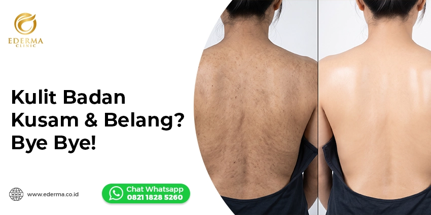 body peeling kulit kusam belang Ederma Clinic Lombok