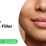 Bibir-Tipis-Kenali-Lip-Filler