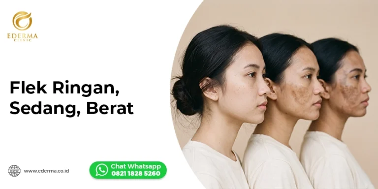 Treatment Flek Hitam: Flek Ringan, Sedang, hingga Berat
